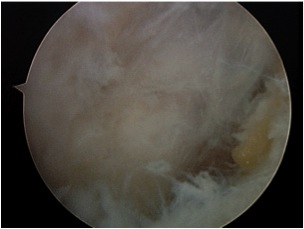 FHL Arthroscopic Release 1